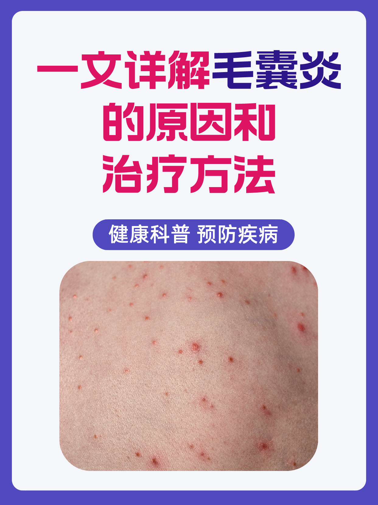 一文详解毛囊炎的原因和治疗方法!