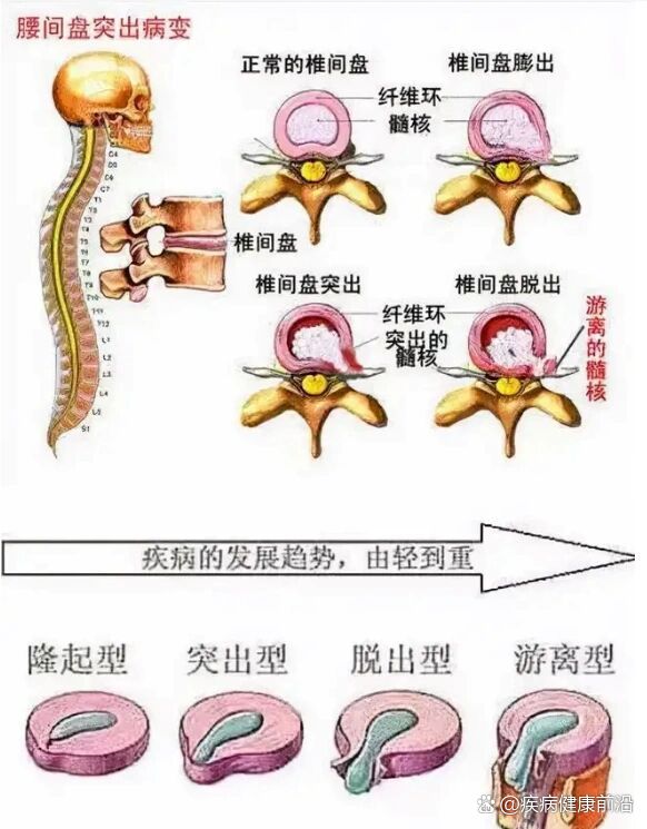 腰椎间盘膨出