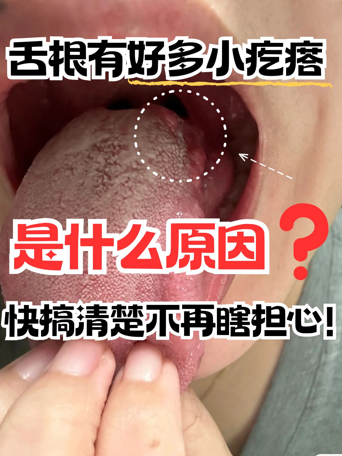 舌根有好多小疙瘩是什么原因?快搞清楚不再瞎担心!