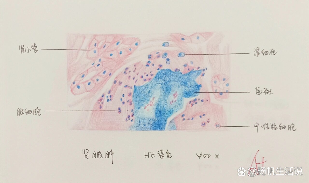 肾脓肿切片绘图图片