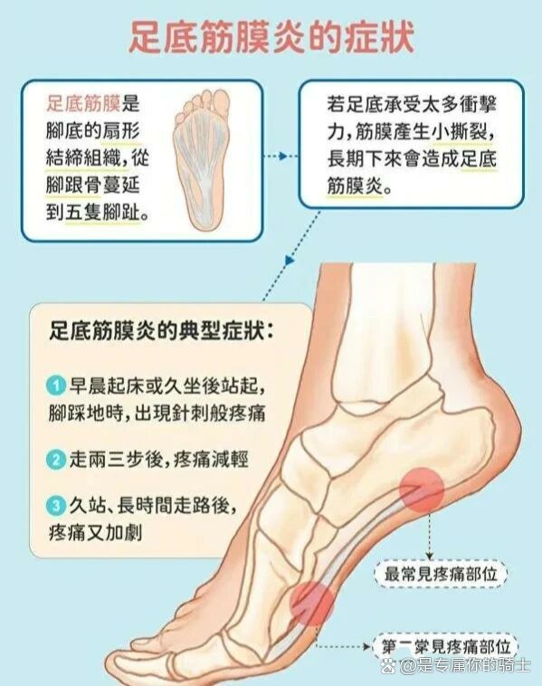 足底筋膜炎位置示意图图片