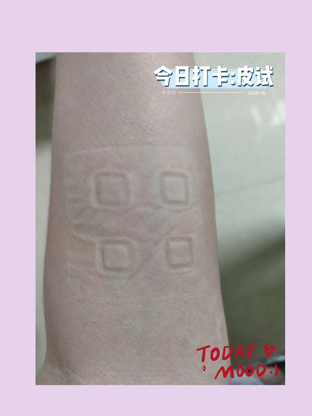 斑贴试验是化妆品测定皮肤过敏常用试验