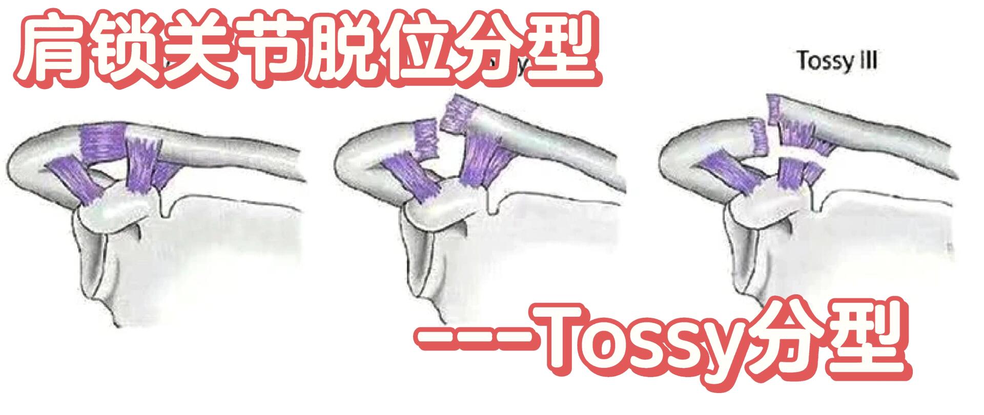 肩锁关节脱位ppt图片