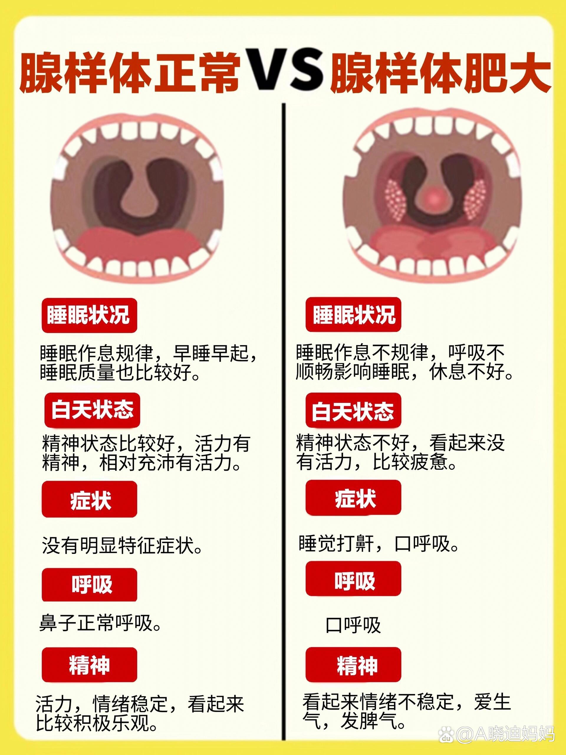 宝宝腺样体肥大有这些表现"自测 方法