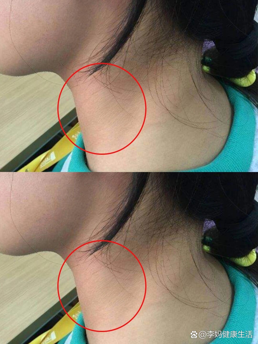 " br>"我的甲状腺结节不疼不痒,不需要治疗吧" br>相信这是绝大多数