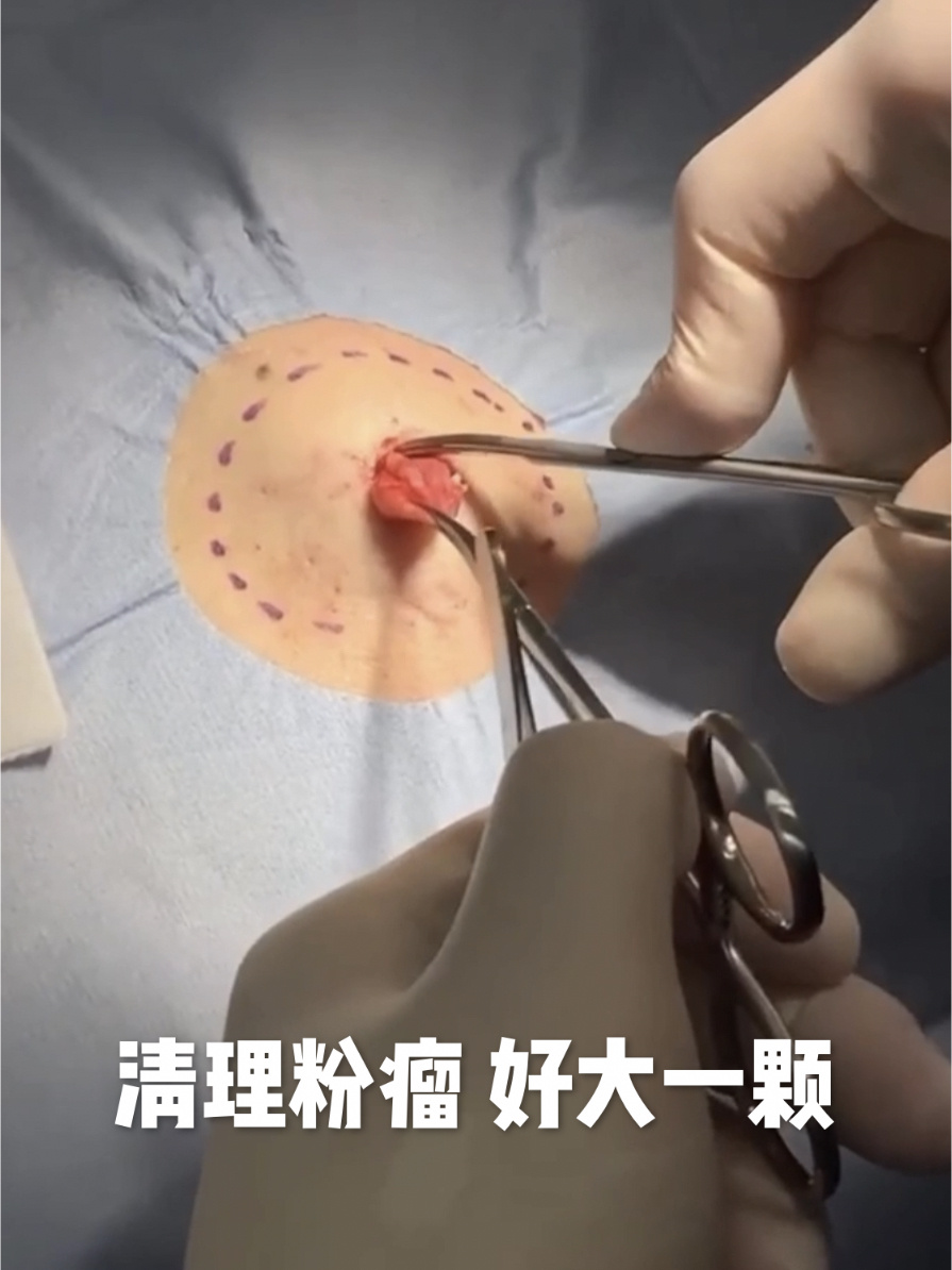 清理粉瘤 好大一颗 解压视频 治愈强迫症