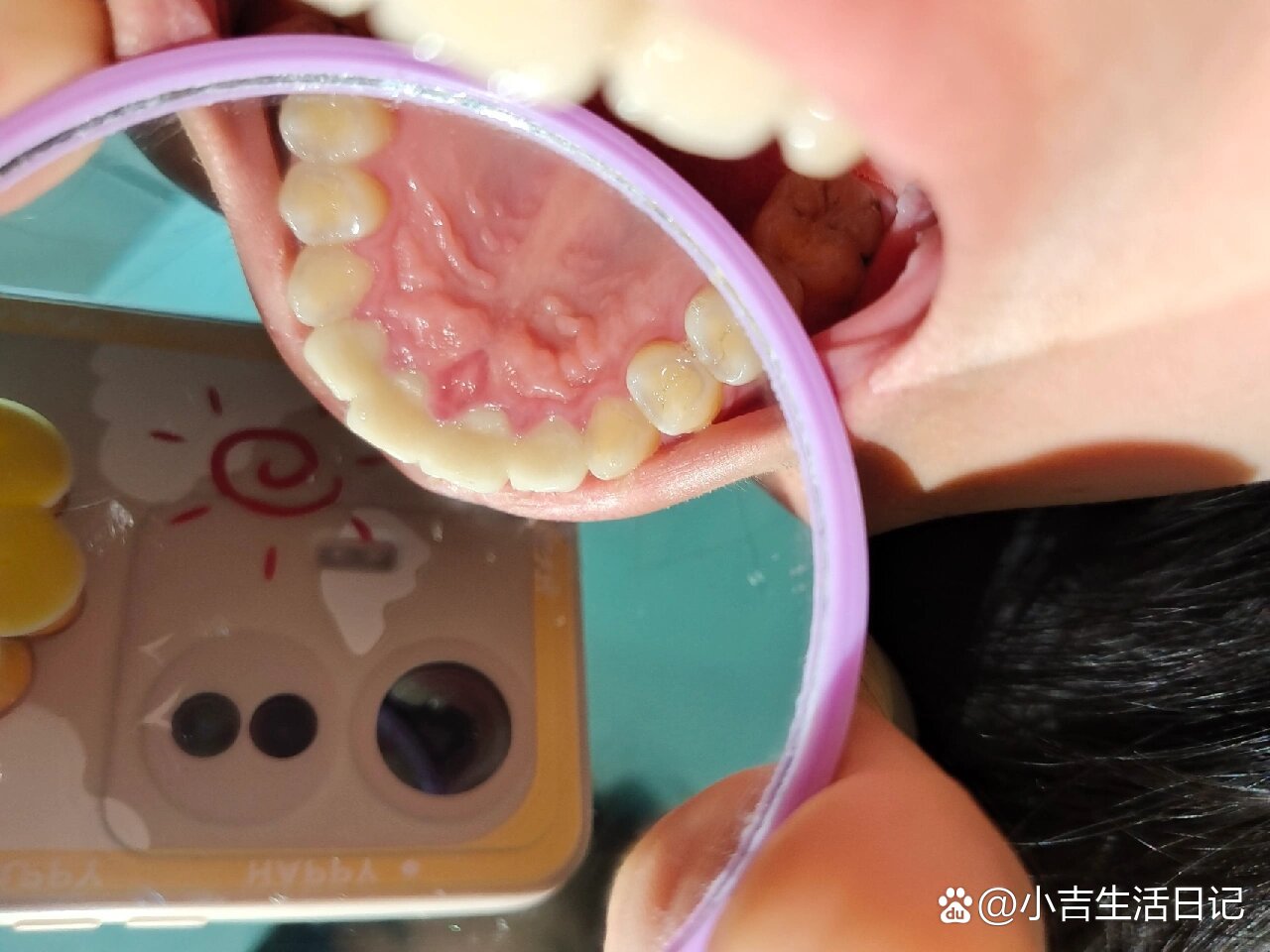 带了牙冠门牙内侧中间一直红红的凸起正常吗
