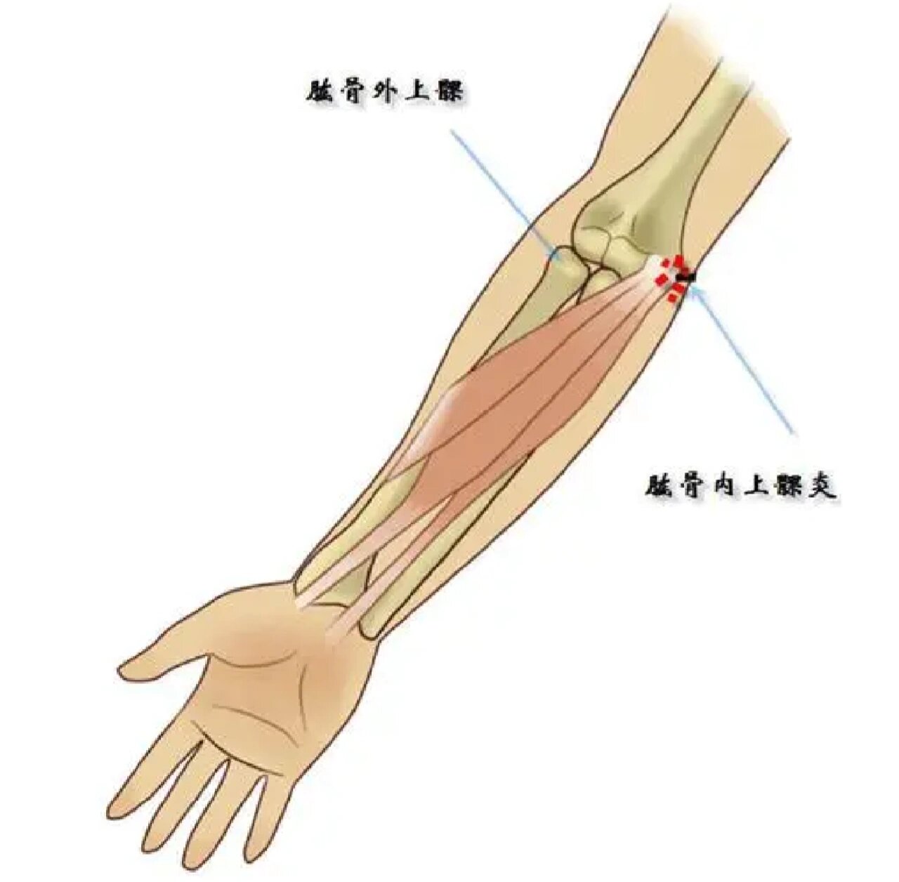 肱骨外上髁炎位置图图片