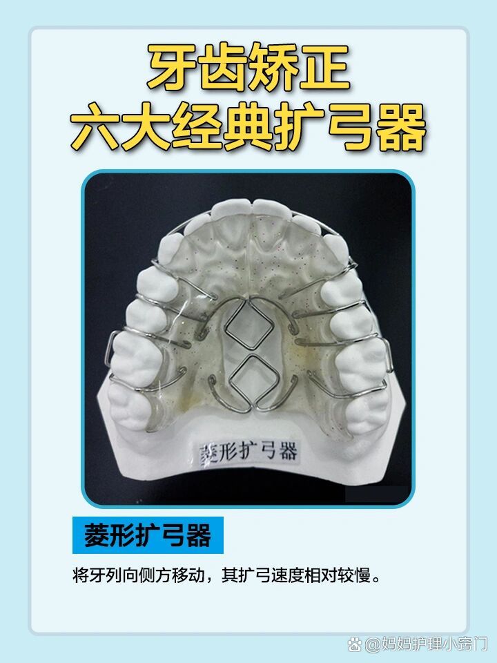 戴扩弓器的宝宝们快过来(建议收藏)