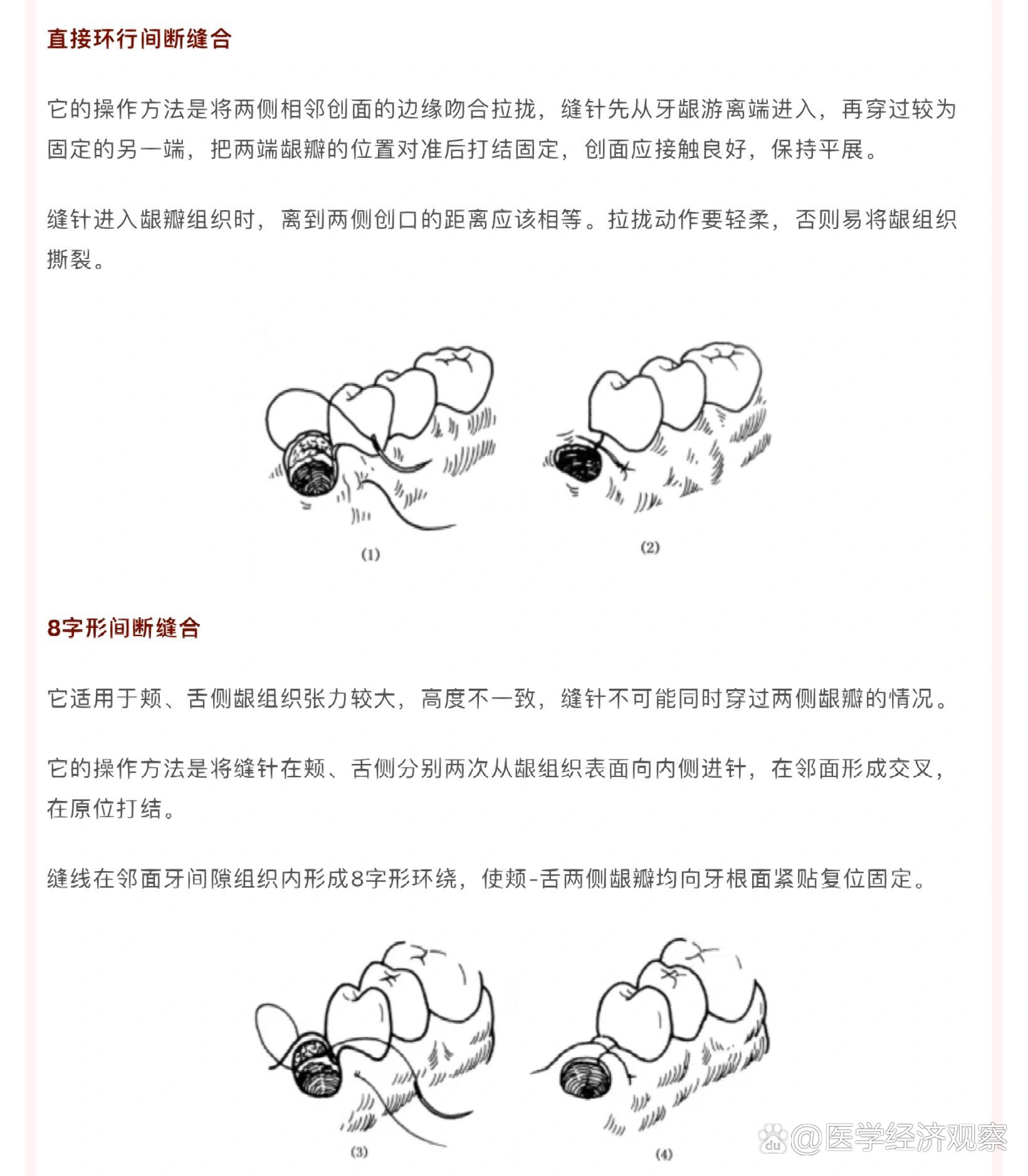 口腔小技巧|口内缝合技术要点总结