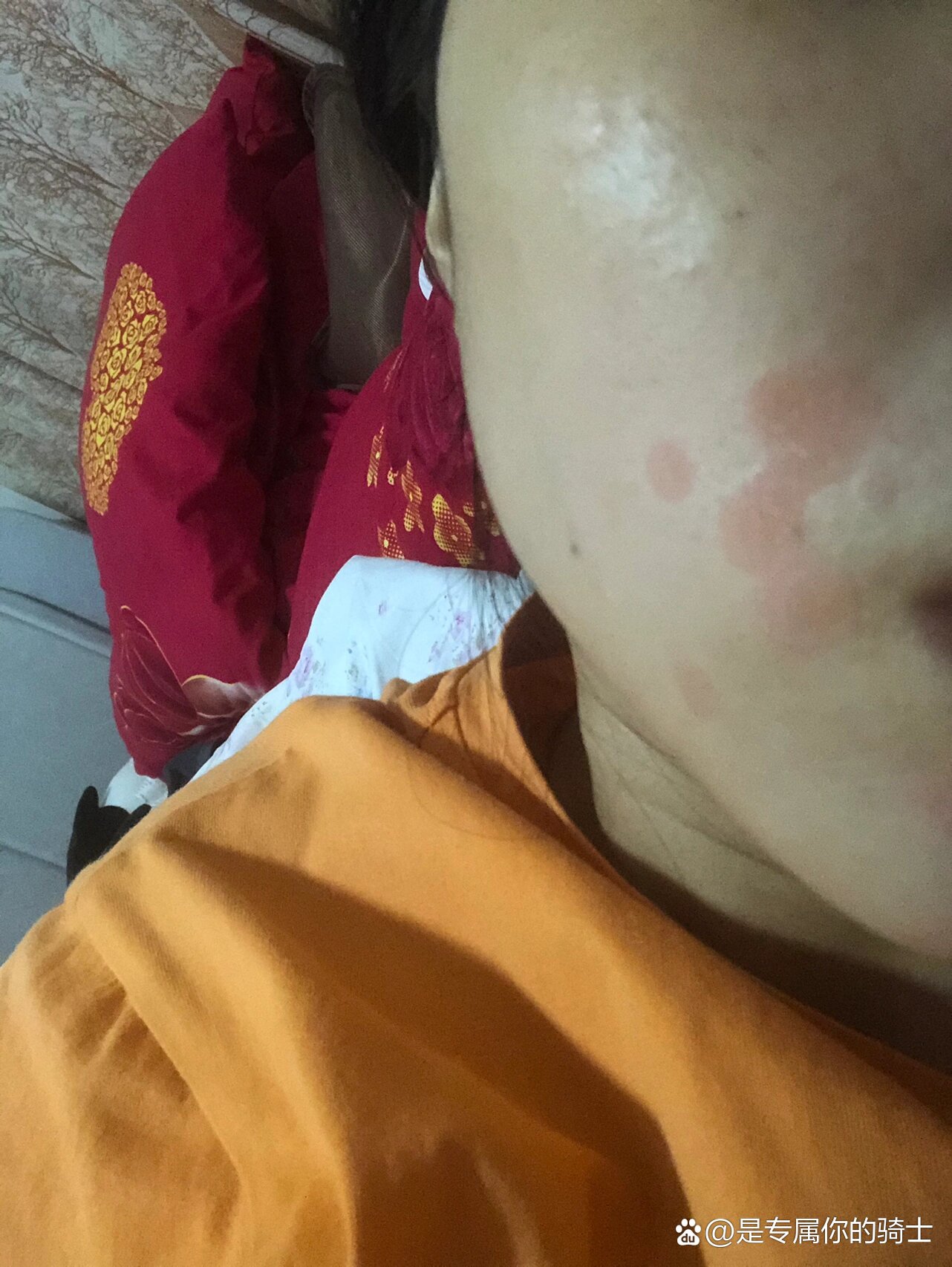 面部红斑,在线求助