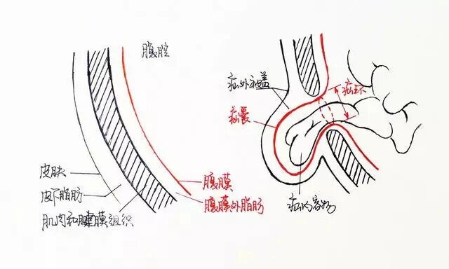一图看懂直疝与斜疝区别