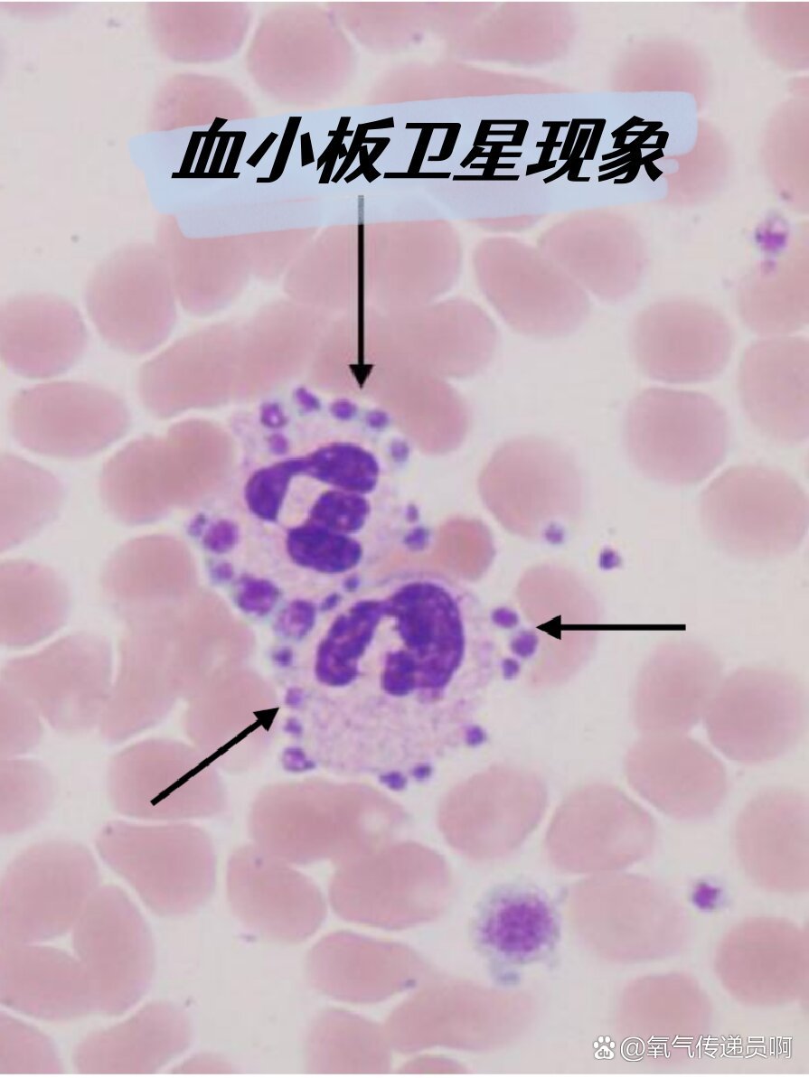 血小板卫星现象