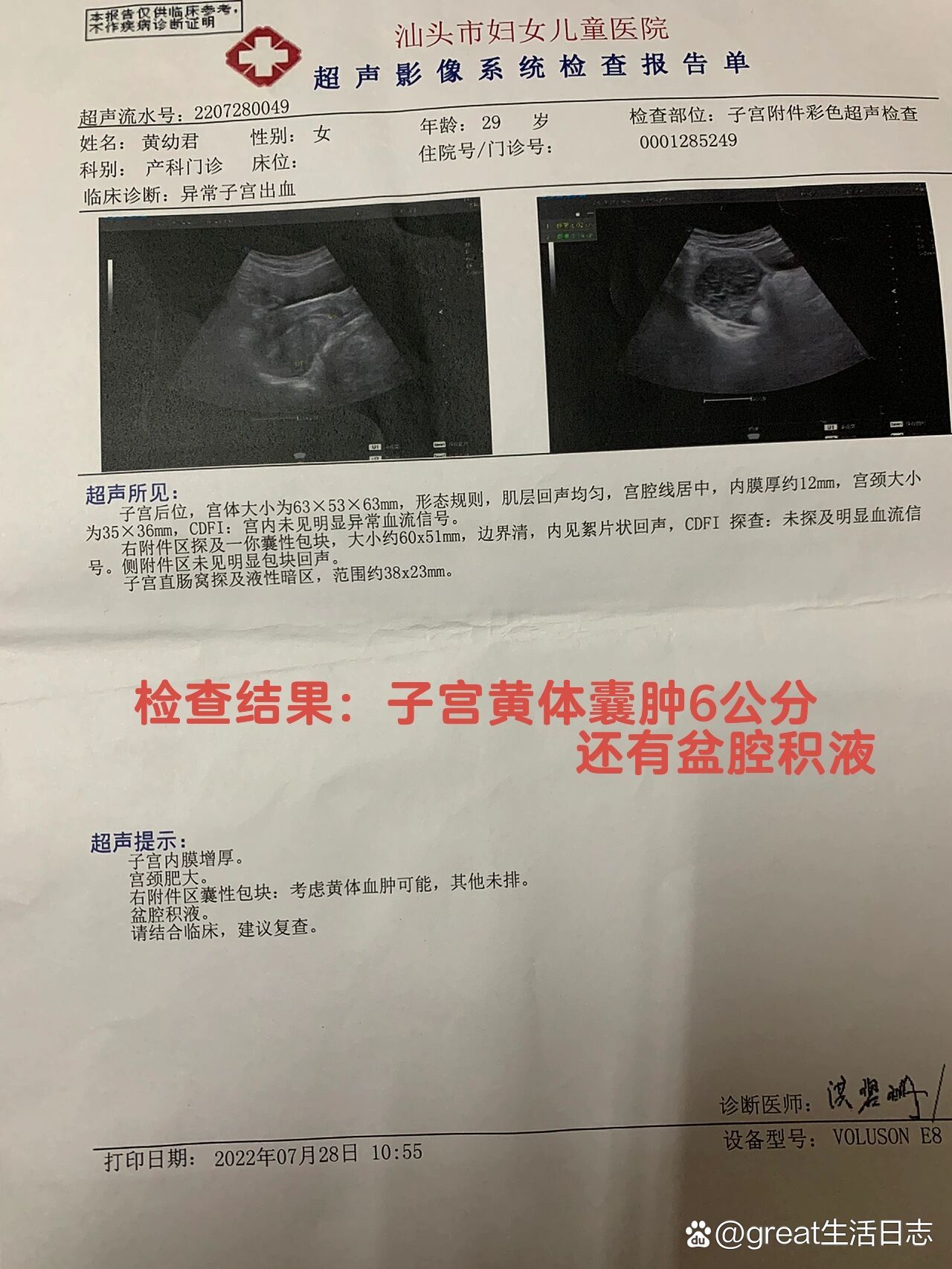 黄体囊肿6公分消失不见
