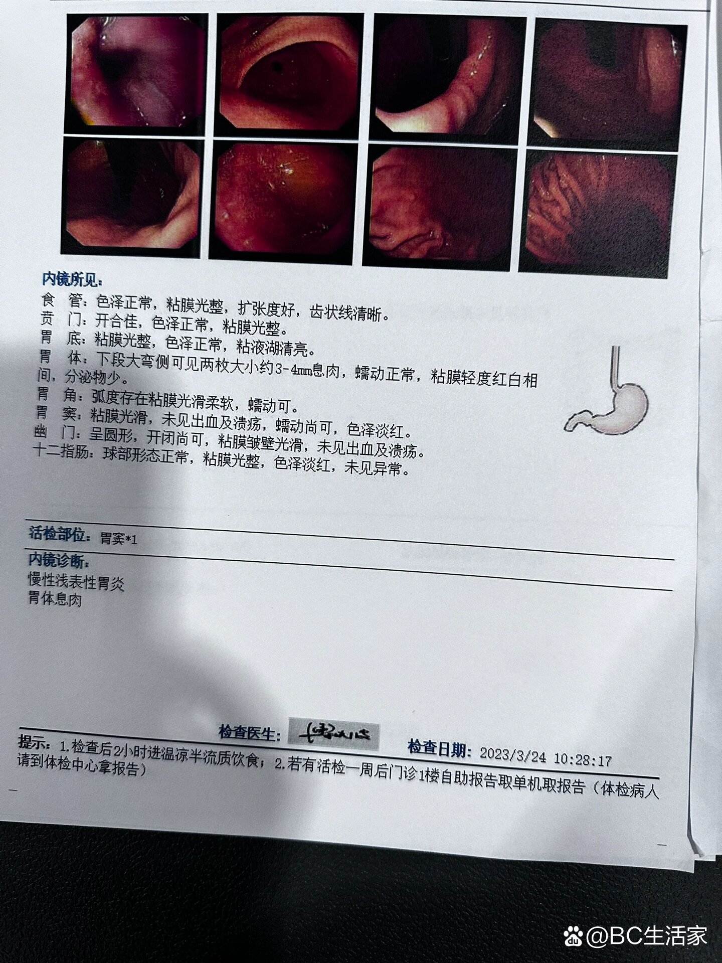 肠镜正常结果图片图片