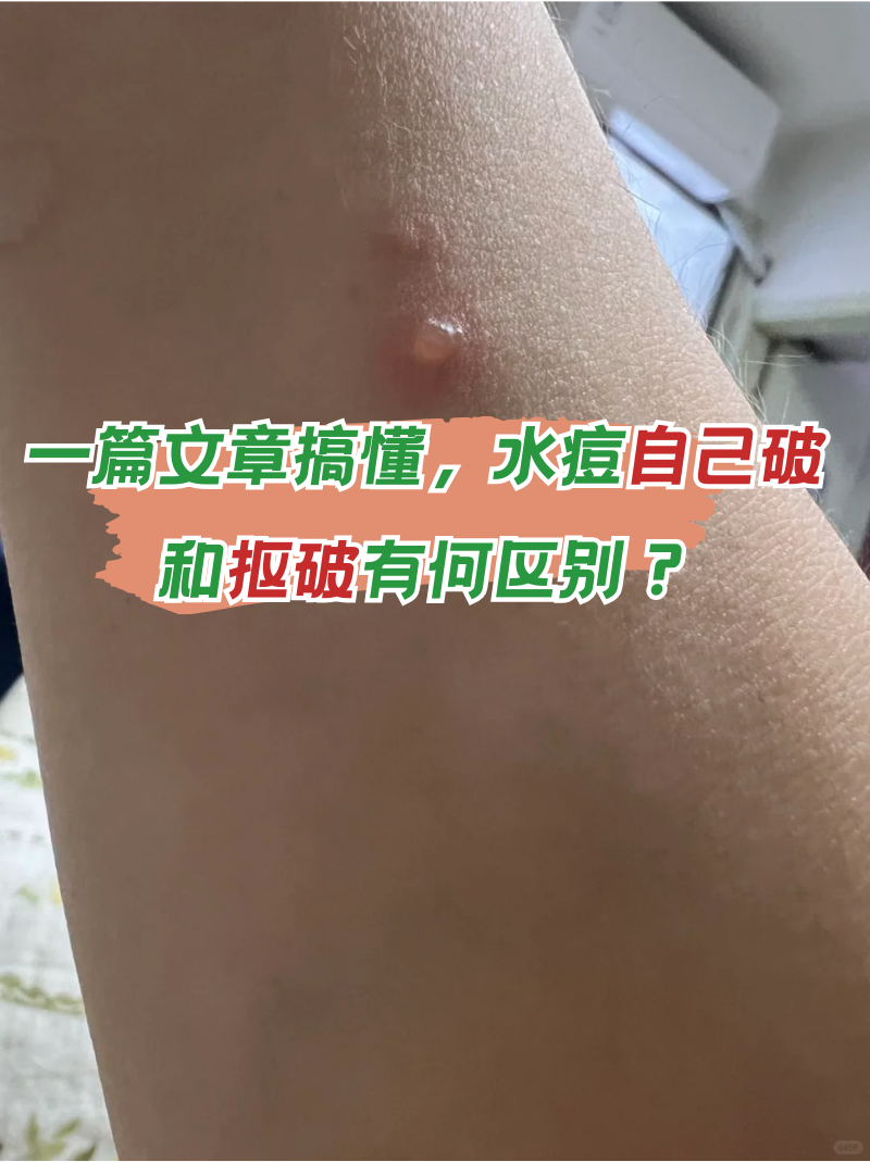 一篇文章搞懂,水痘自己破和抠破有何区别?
