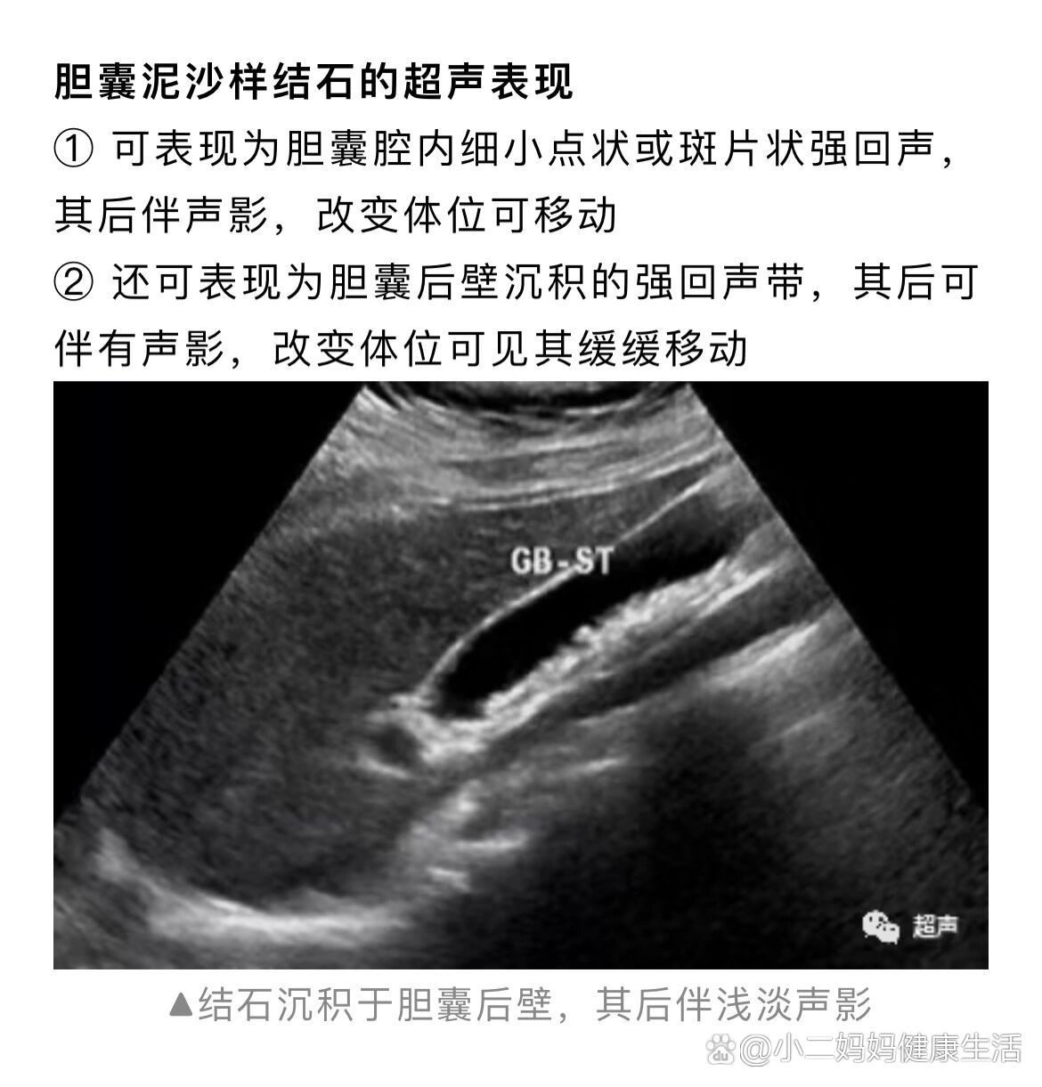 胆囊泥沙样结石