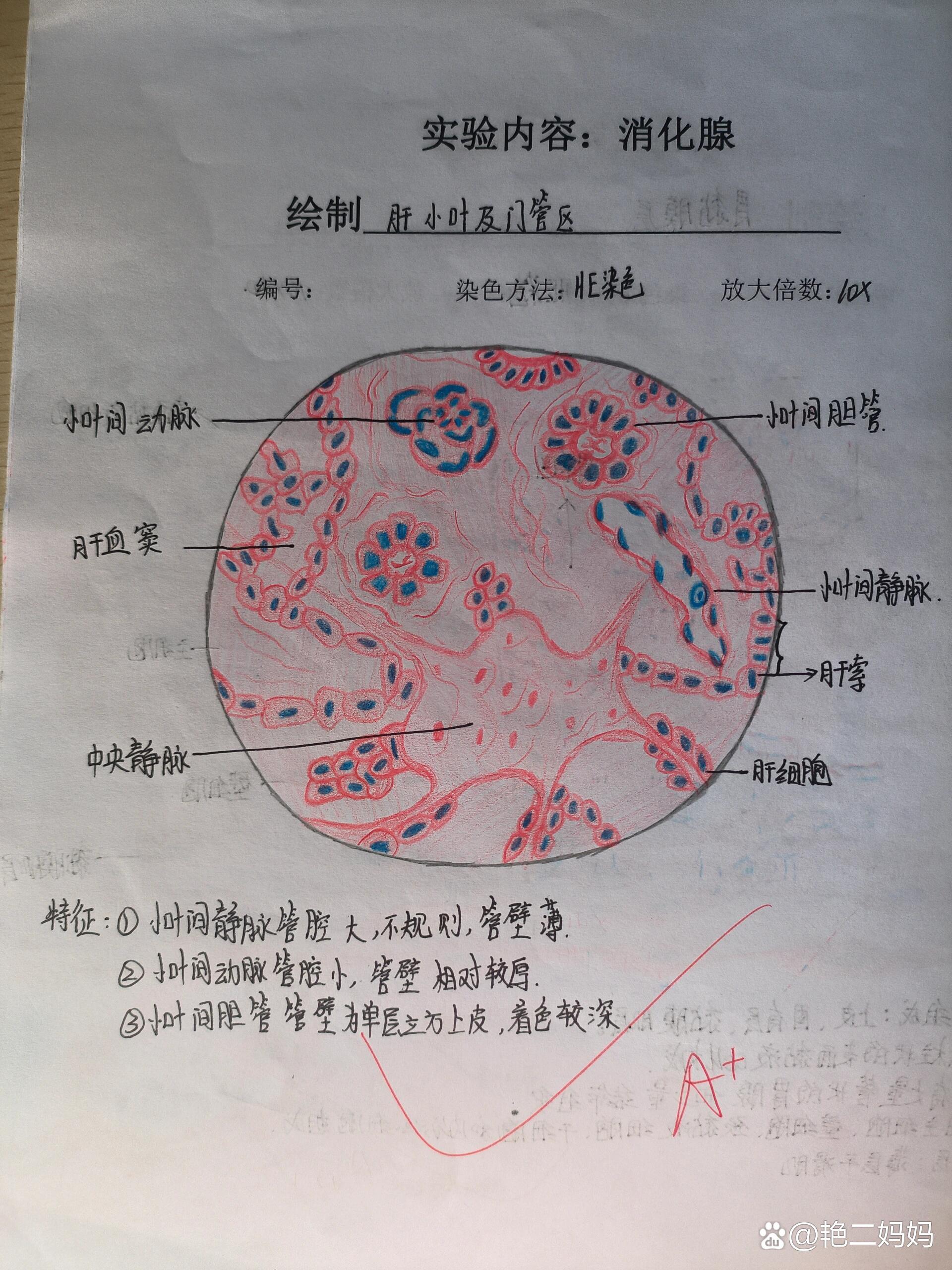 肝硬化假小叶手绘图图片