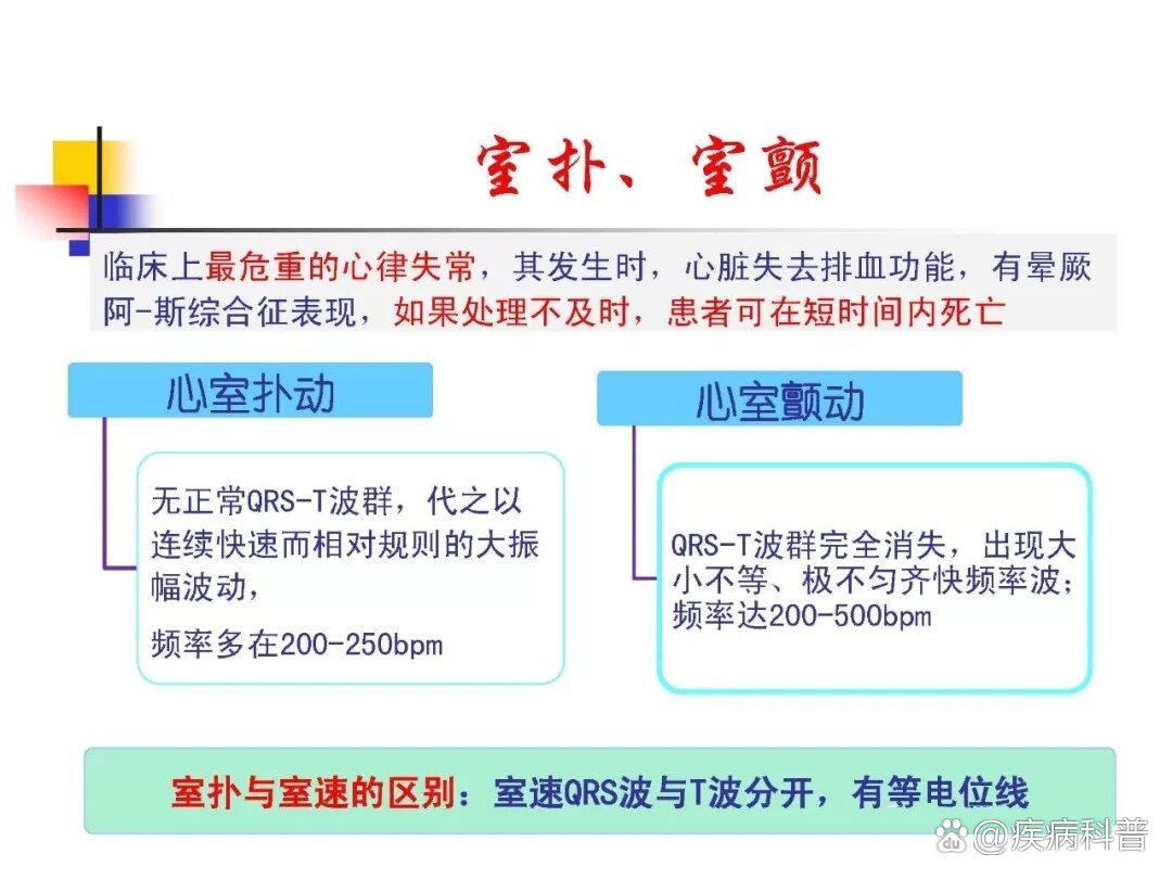 室扑与室颤的区别图解图片