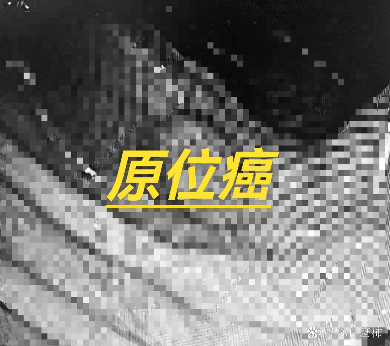 王先生今年56岁，单位组织体检时，他发现一个叫做“癌胚抗原（CEA）”的指标偏高。