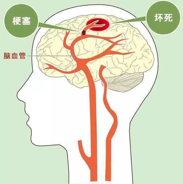 发病与动脉粥样不,心脏病,血流动力学改变,微栓塞及血液成分变化等