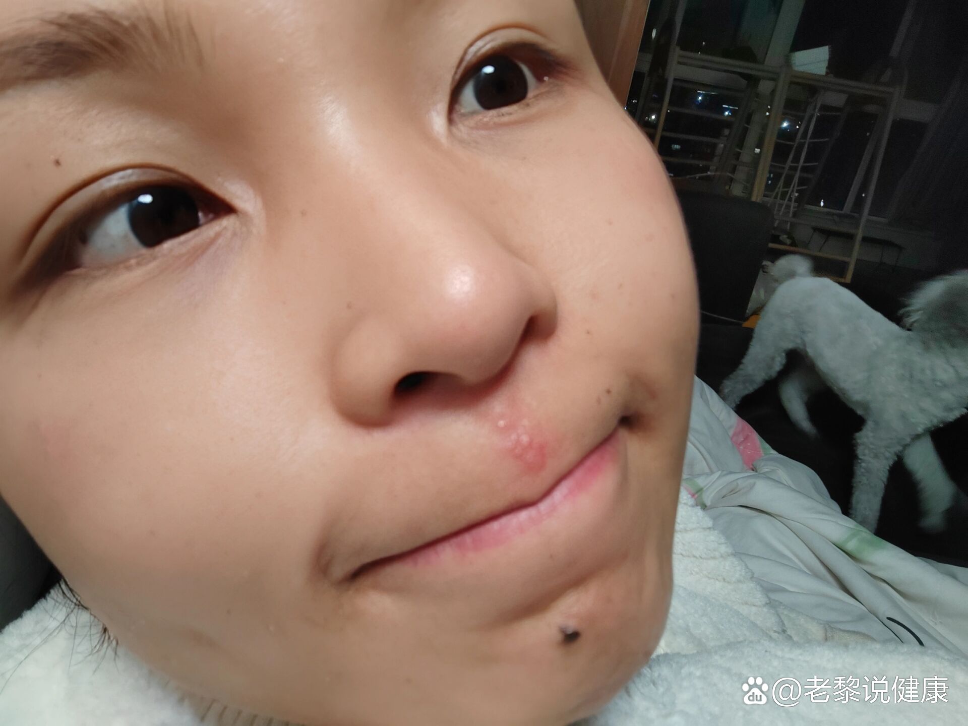  p>单纯疱疹好烦啊啊啊 br>中午健完身自拍发现人中红红的 到了晚上就