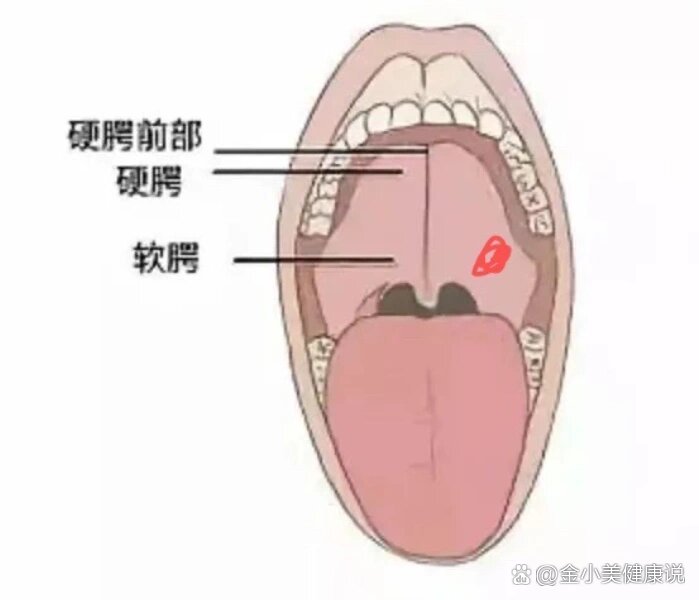 软腭浅表溃疡图片