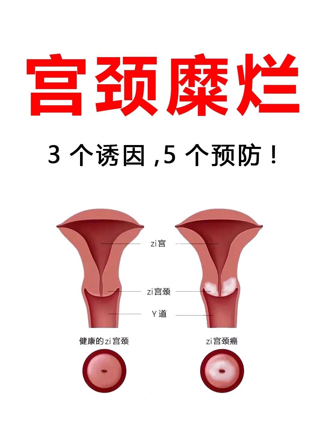 宫颈糜烂2度严重吗图片