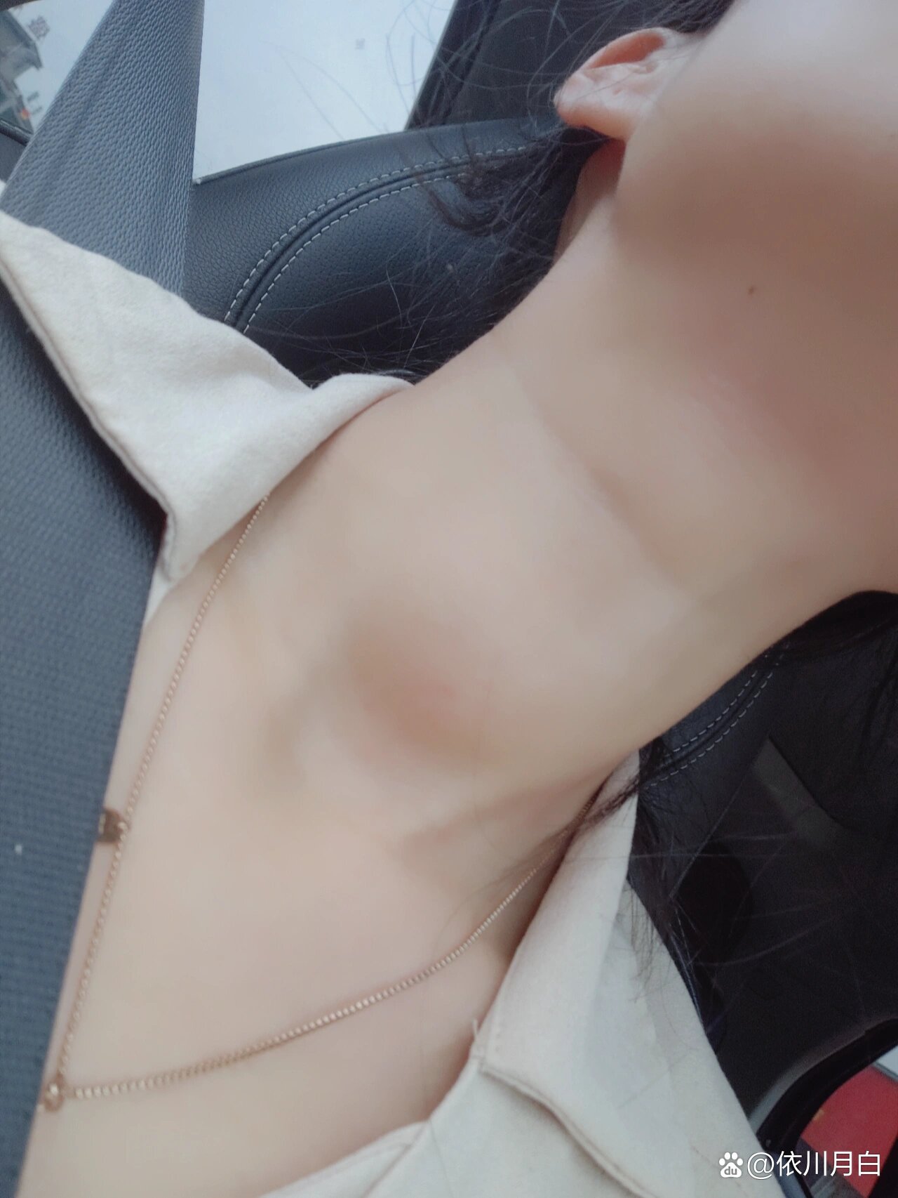 甲亢大脖子