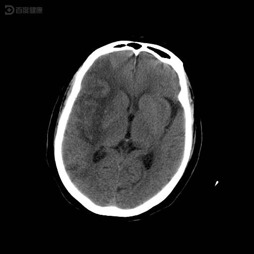 60岁江大叔心源性脑栓塞的治疗过程分享