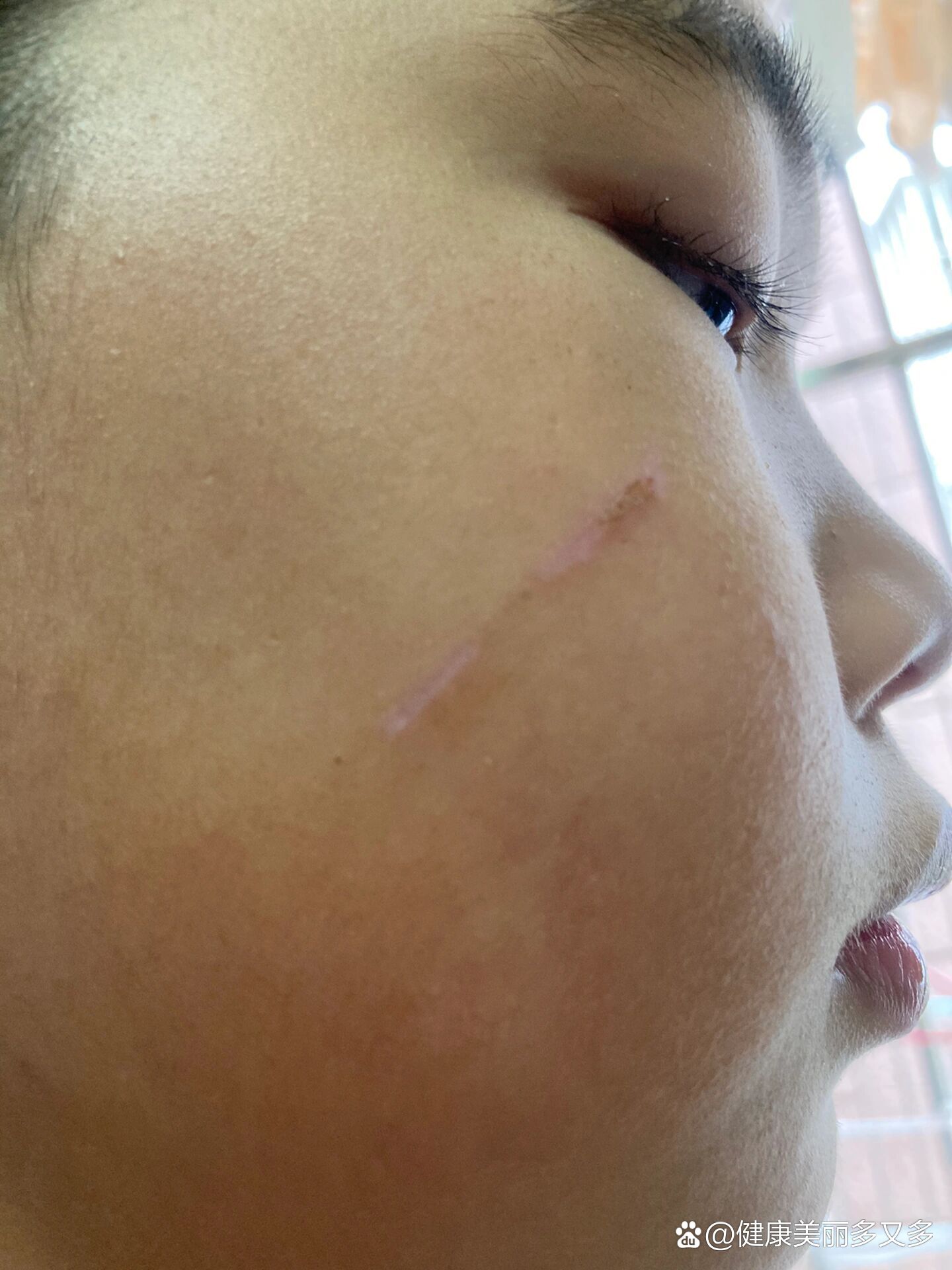 抓伤第九天,请问大家这样会留疤吗