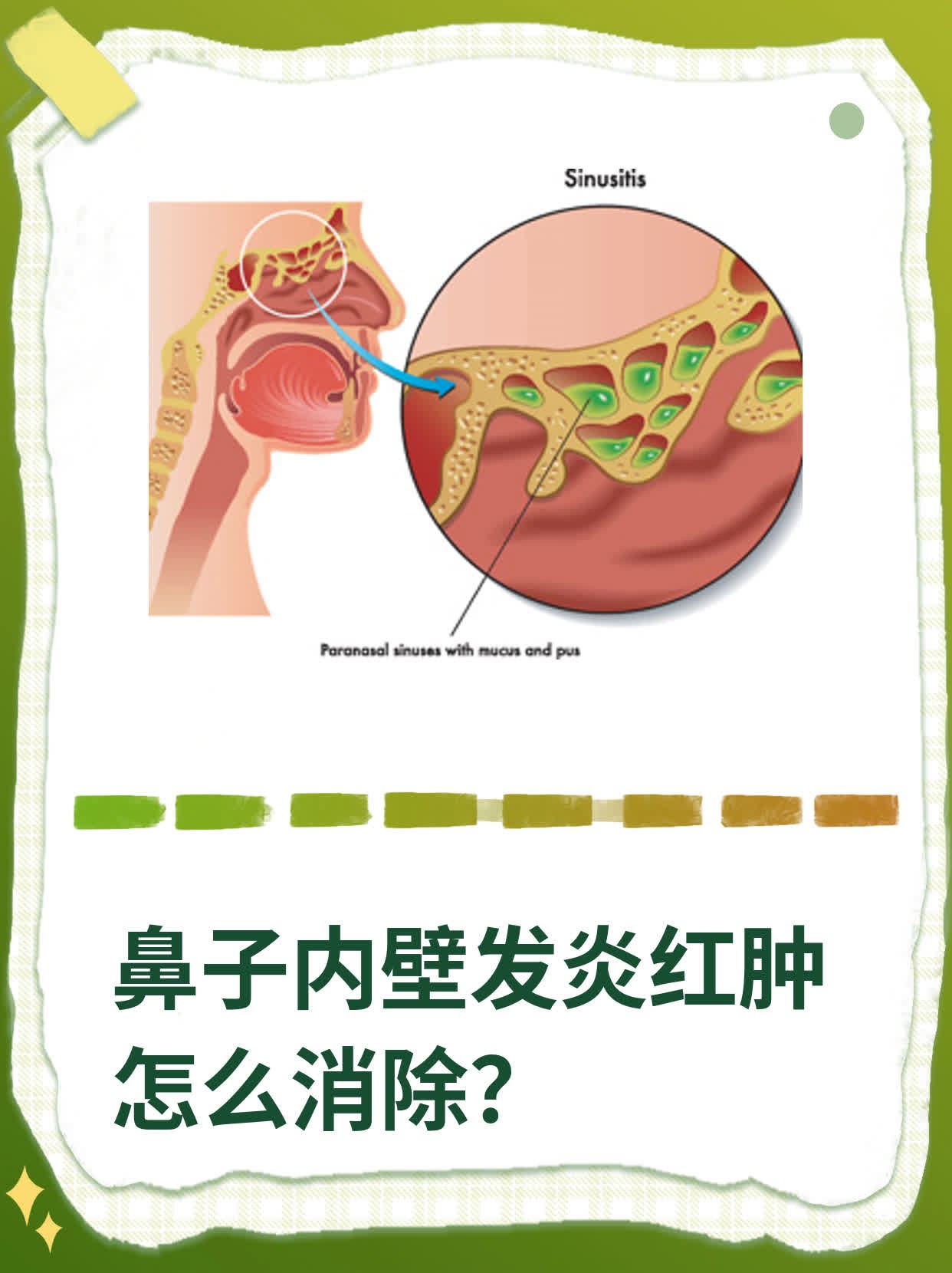 鼻子内壁发炎红肿怎么消除