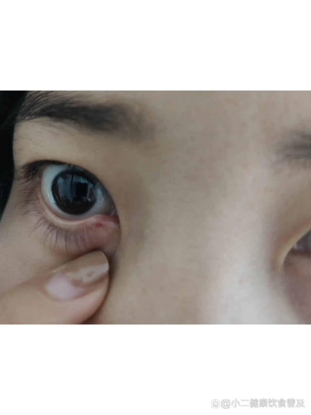  p>😭泪腺炎怎么办 br> 昨天早上发现眼角肿了,又痒,中午去诊所看