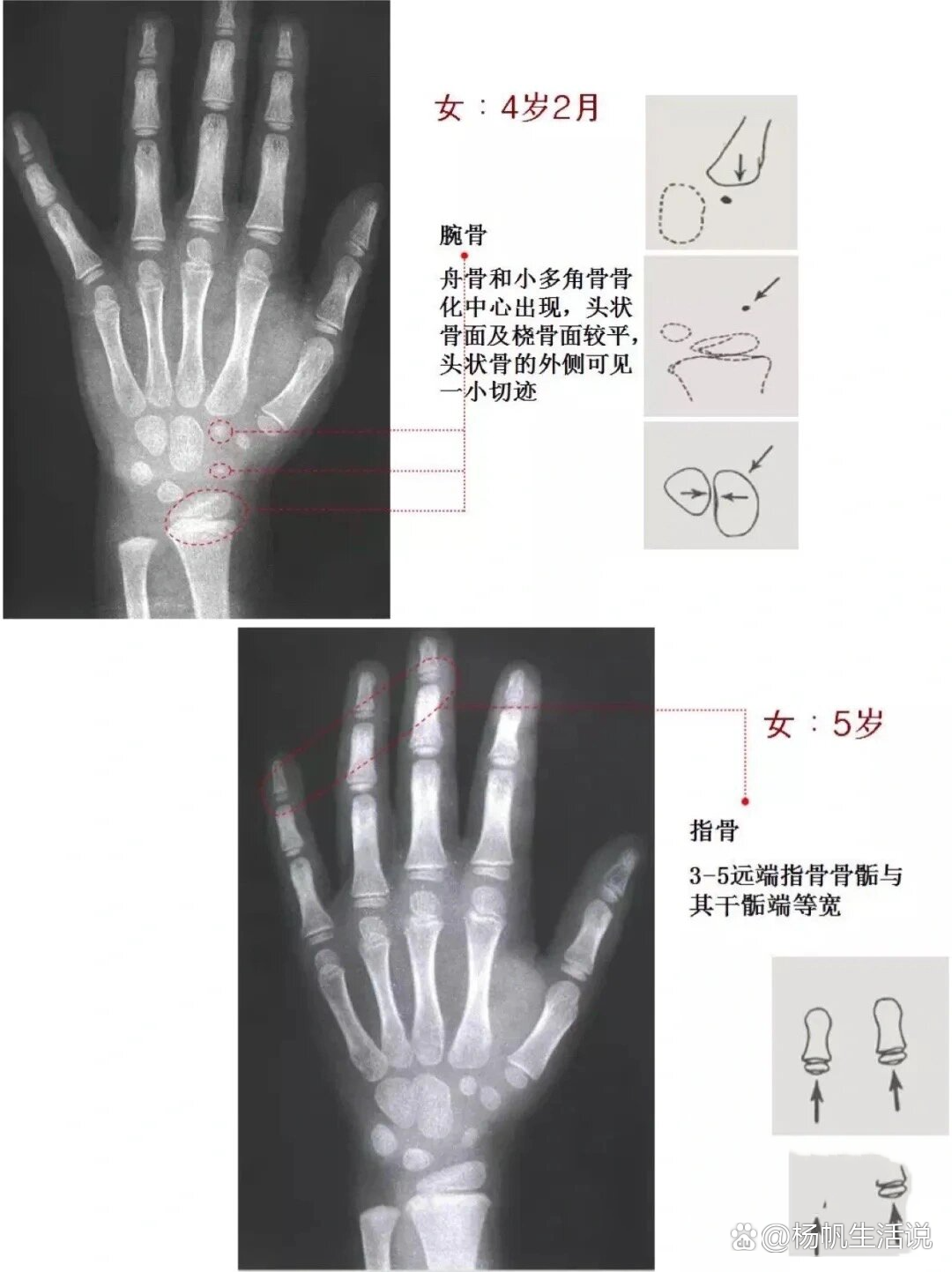 女童骨龄图谱