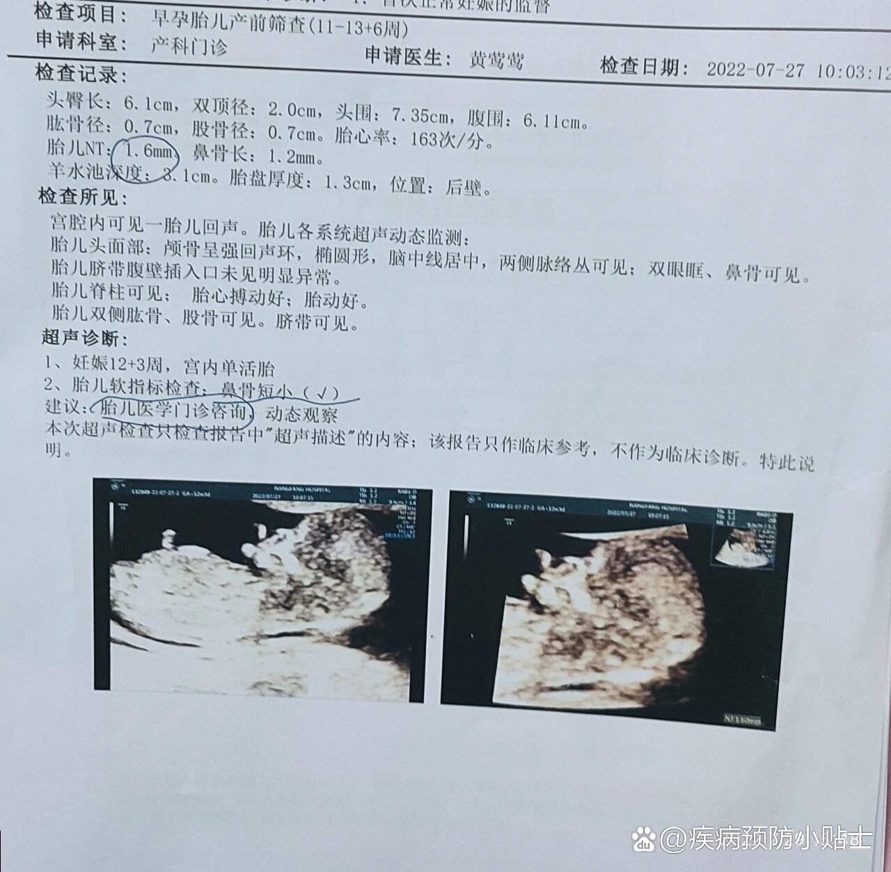 nt结果显示鼻骨短小,医生建议进一步检查.