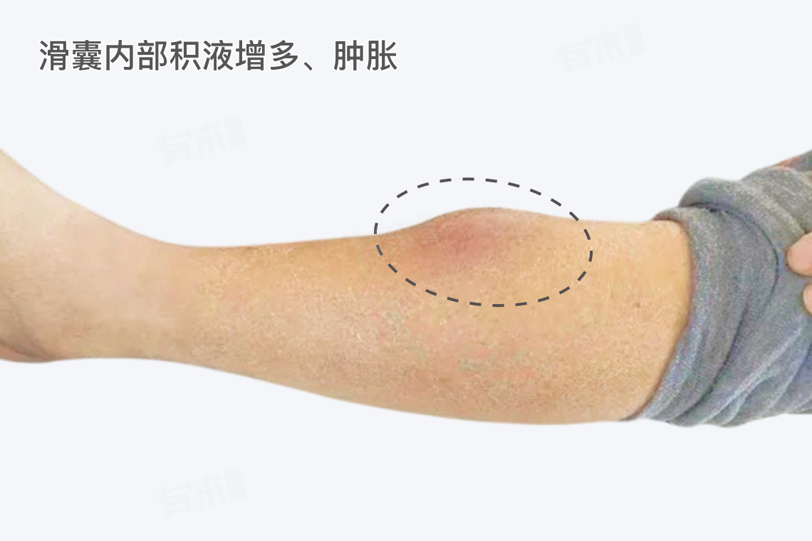 滑囊炎症状及治疗方法
