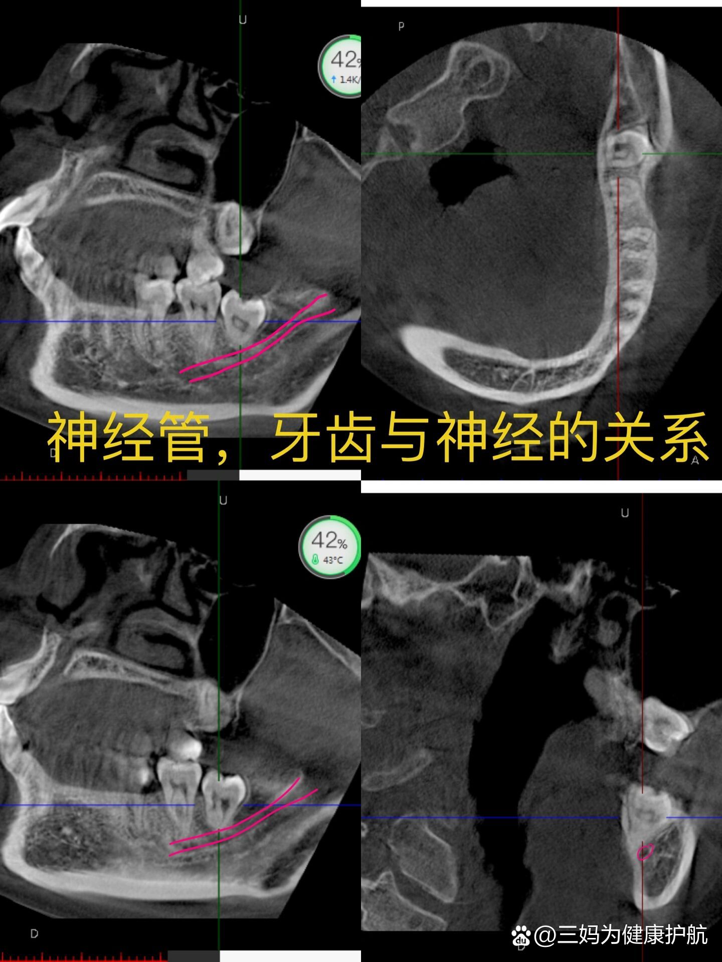 智齿挨着神经管图图片