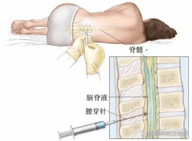 骨穿怎么做图片大全图片