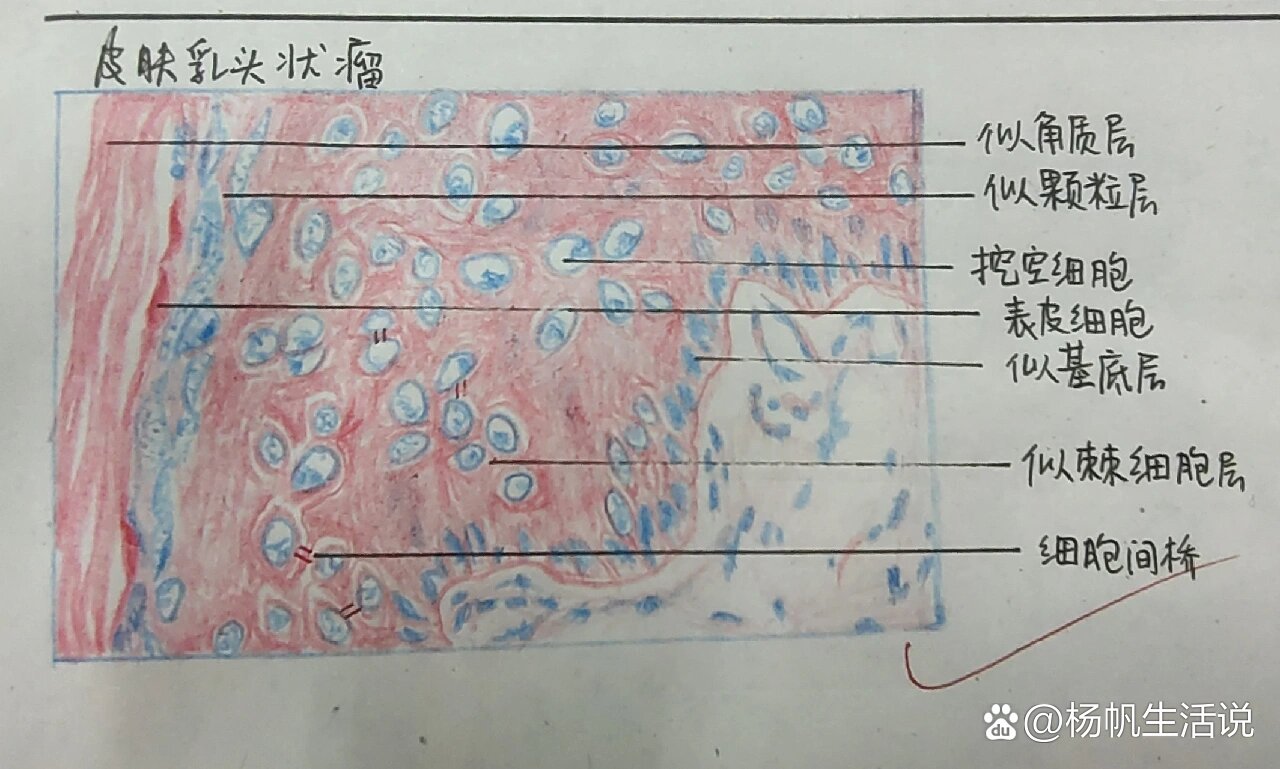 皮肤乳头状瘤画图图片