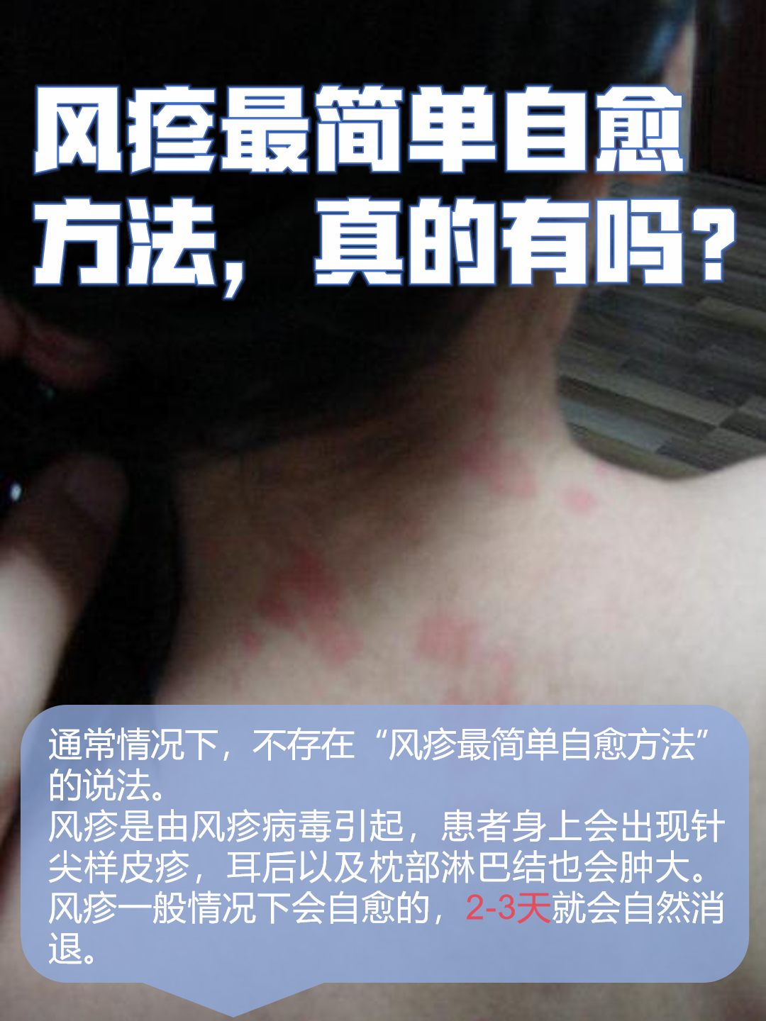 风疹最简单自愈方法,真的有吗?