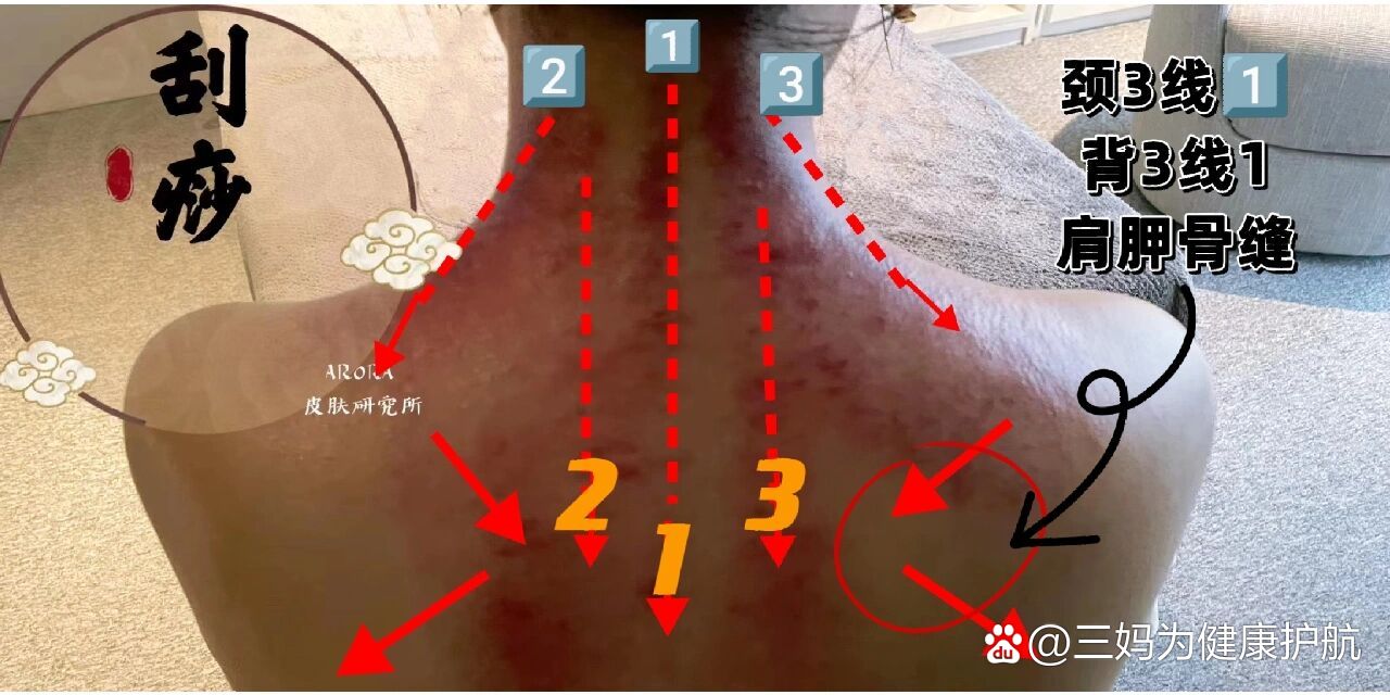 颈椎疼刮痧刮哪里图解图片