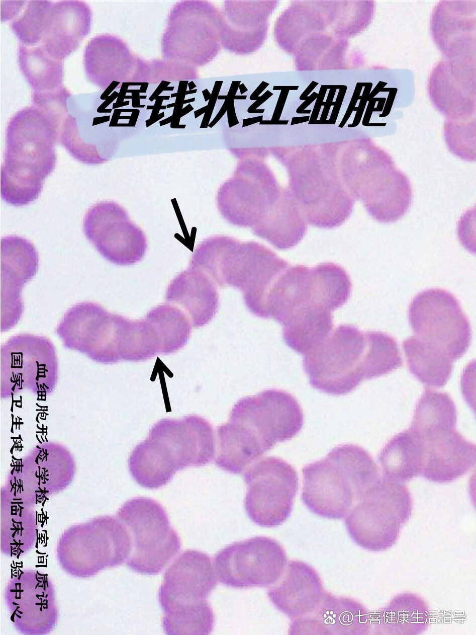 红细胞缗钱状排列图片图片