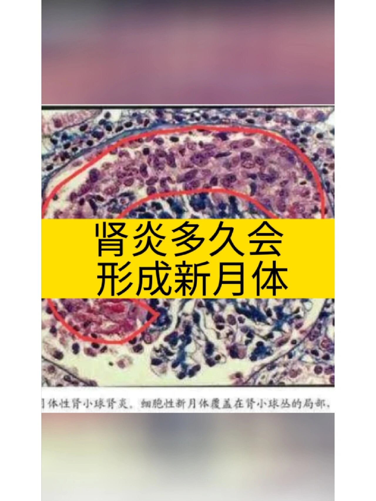 若可形成新月体,一般在发病之初即可出现,一开始叫做细胞性新月体