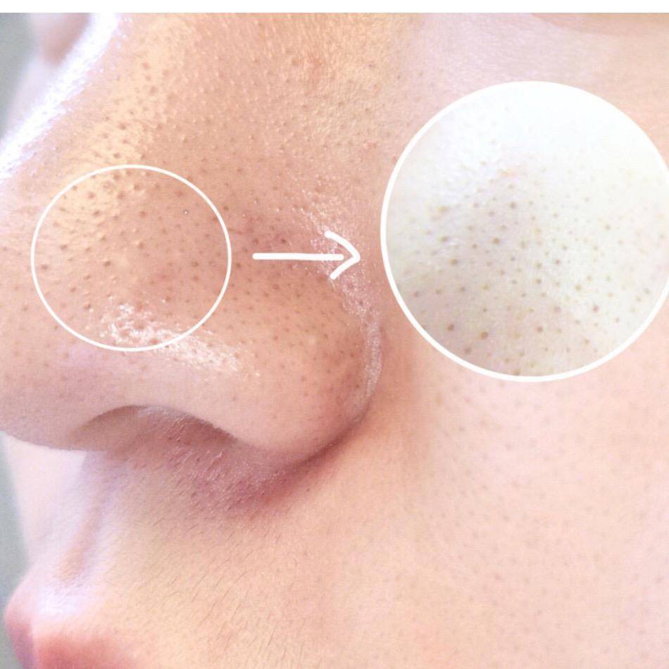 黑头和闭口粉刺的区别有哪些,分享关于果酸换肤的一些误区