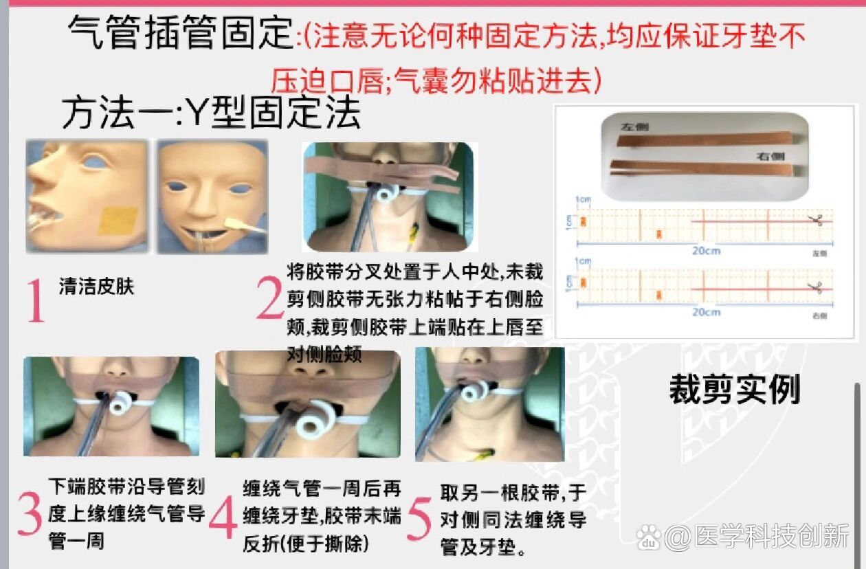 双腔气管导管插管技巧图片