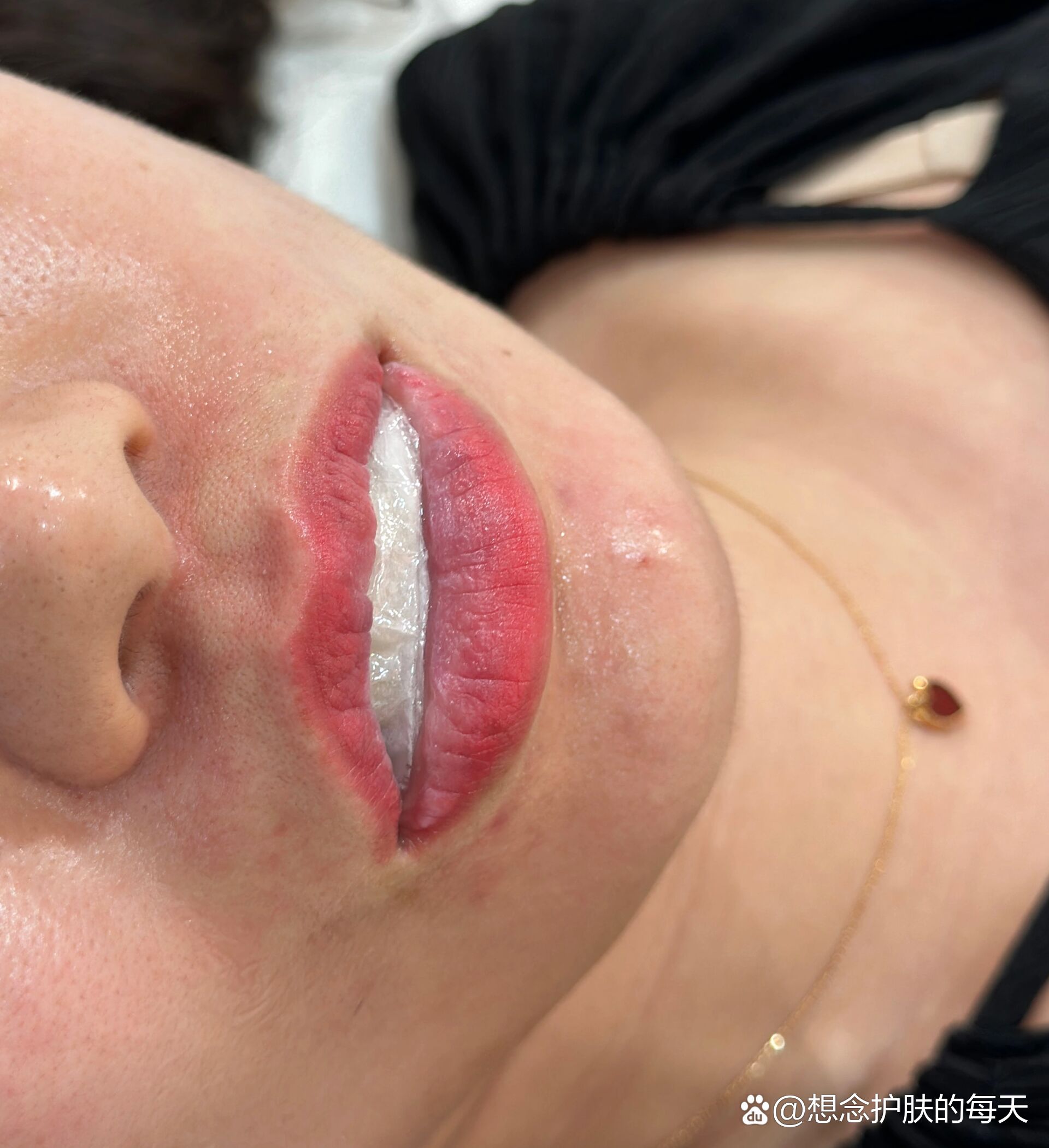 老式纹唇改马生少女唇