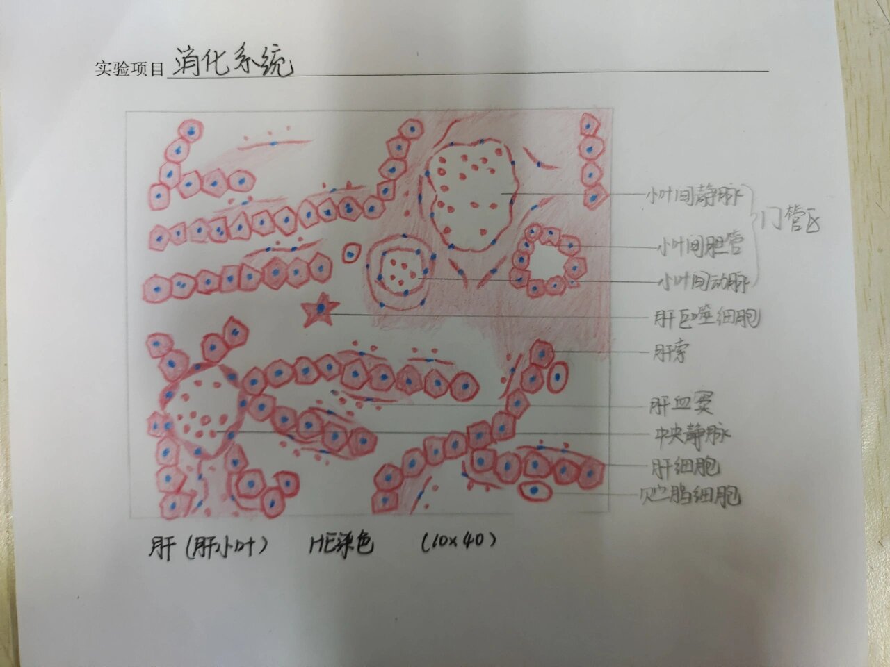 肝硬化假小叶手绘图图片