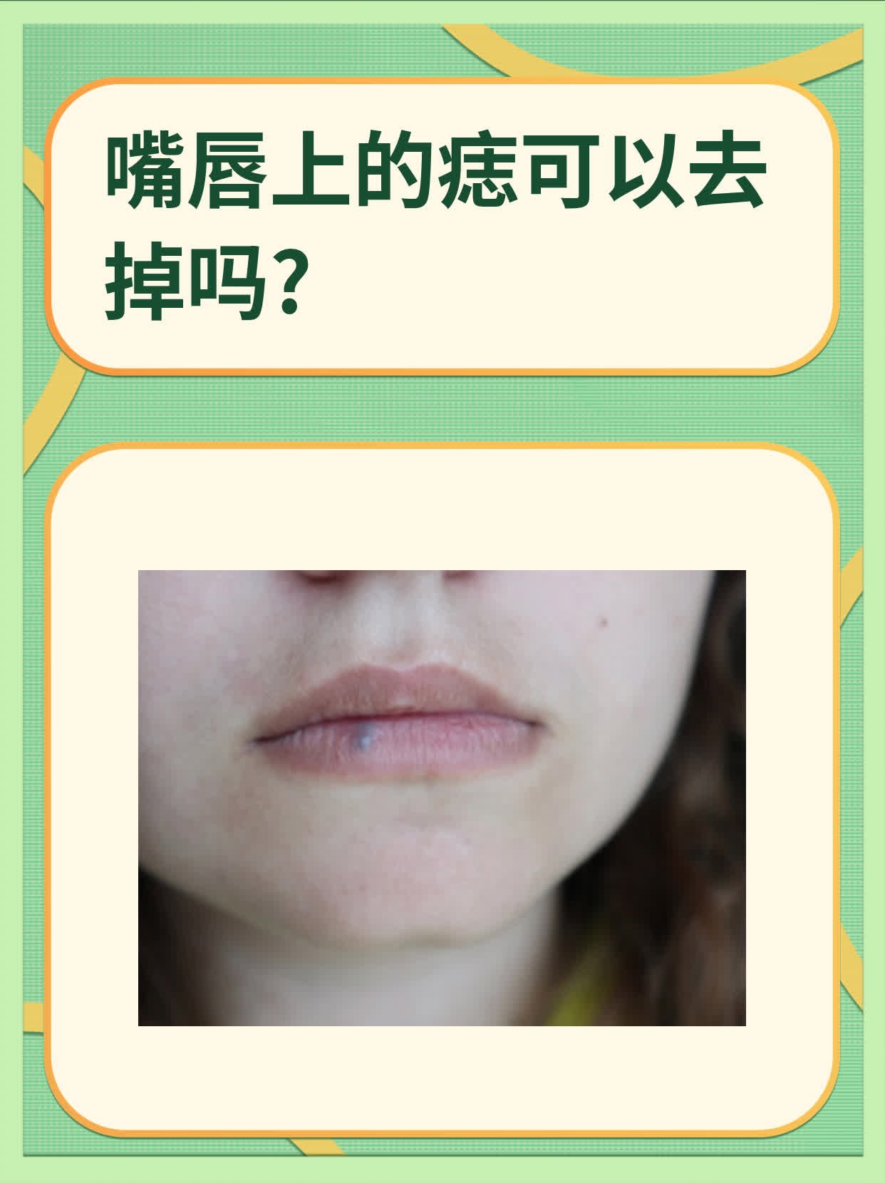 嘴唇上的痣可以去掉吗