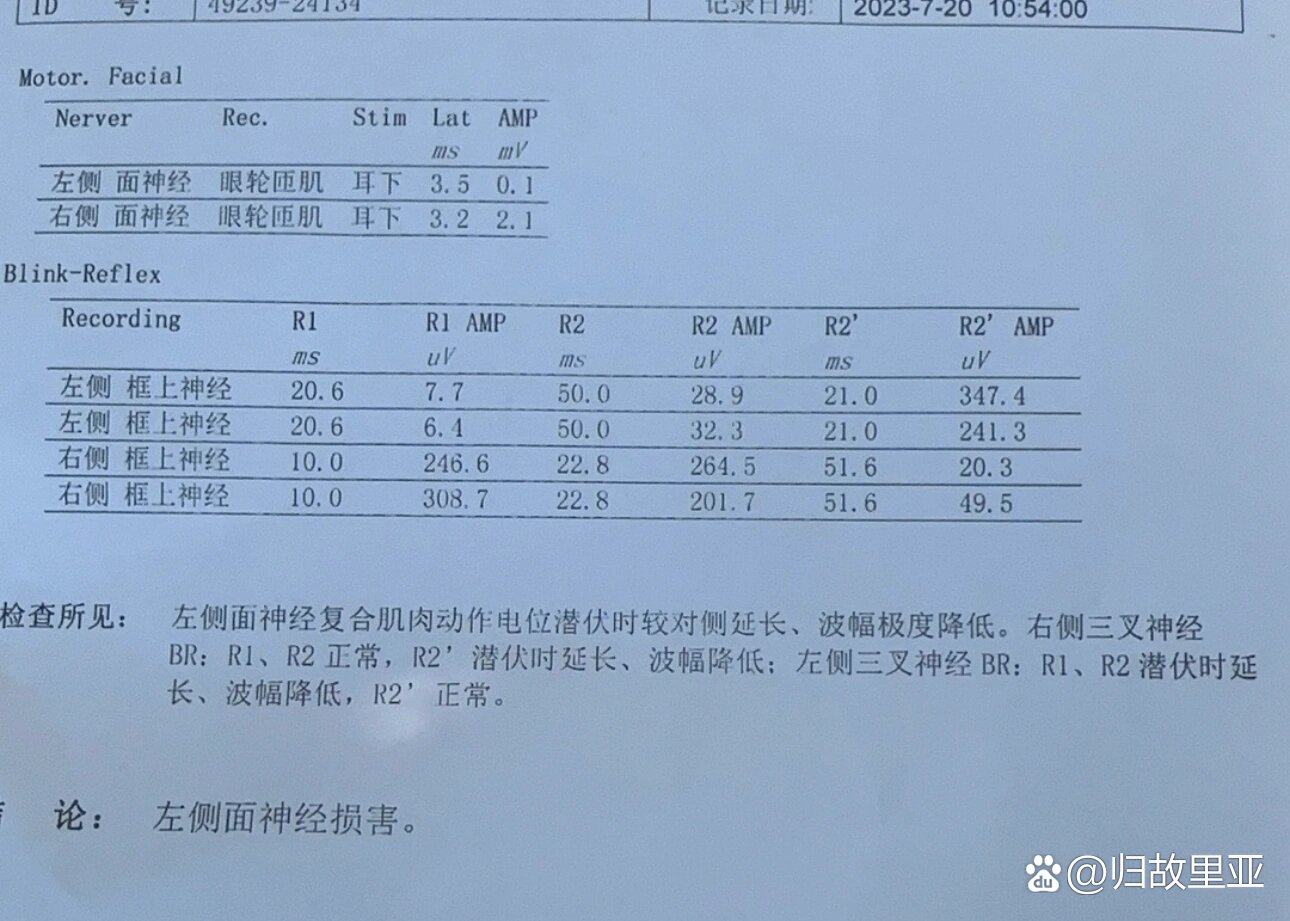 面神经肌电图结果解读图片