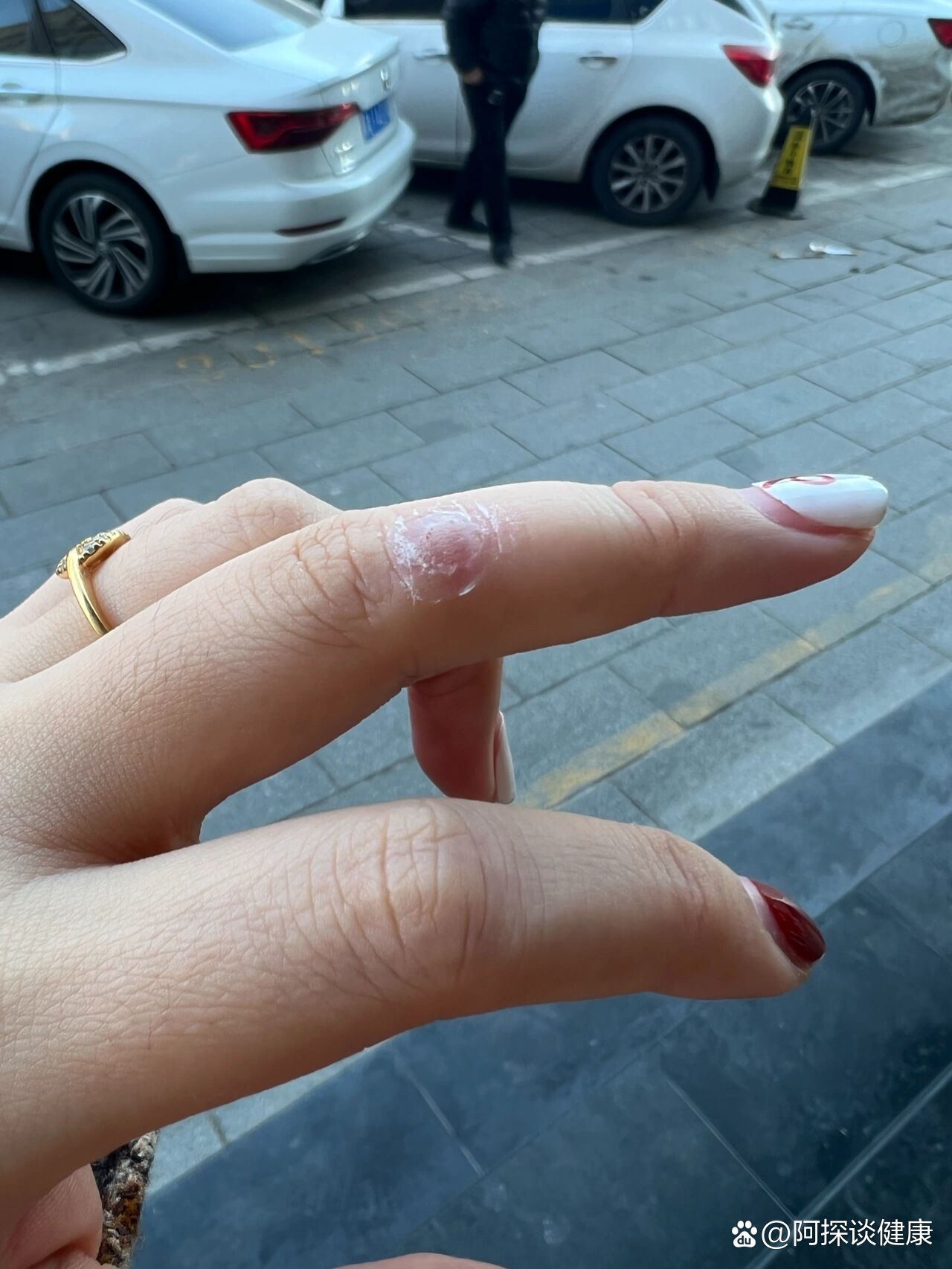 我左手手指上长了个瘊子